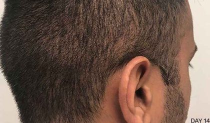 Hair Restoration Before & After Patient #2737
