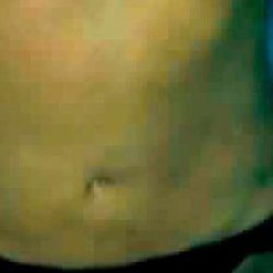 Liposuction Before & After Patient #2817
