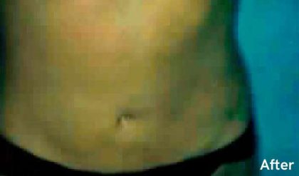 Liposuction Before & After Patient #2817