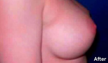 Breast Augmentation Before & After Patient #2196