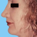Rhinoplasty Before & After Patient #2955