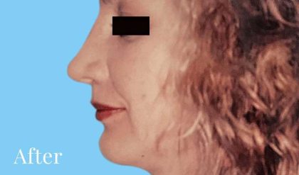 Rhinoplasty Before & After Patient #2955