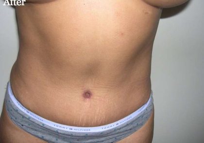 Tummy Tuck Before & After Patient #3045
