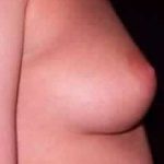 Breast Augmentation Before & After Patient #2196
