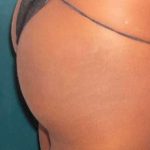 Buttock Augmentation Before & After Patient #2381