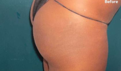 Buttock Augmentation Before & After Patient #2381
