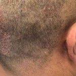 Hair Restoration Before & After Patient #2737
