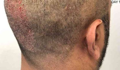 Hair Restoration Before & After Patient #2737