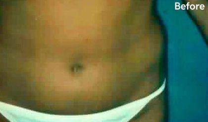 Liposuction Before & After Patient #2817