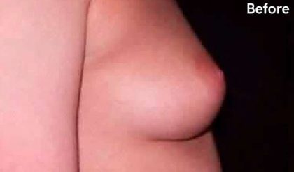 Breast Augmentation Before & After Patient #2196