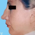 Rhinoplasty Before & After Patient #2955