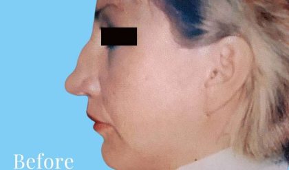 Rhinoplasty Before & After Patient #2955