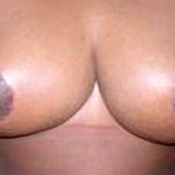 Breast Reduction Before & After Patient #2309