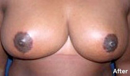 Breast Reduction Before & After Patient #2309
