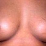 Breast Augmentation Before & After Patient #2199