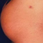 Buttock Augmentation Before & After Patient #2384