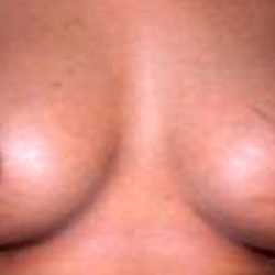 Breast Augmentation Before & After Patient #2199