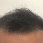 Hair Restoration Before & After Patient #2740