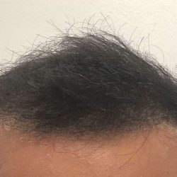 Hair Restoration Before & After Patient #2740
