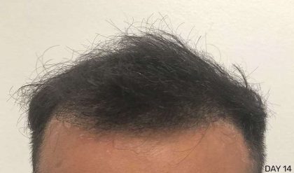 Hair Restoration Before & After Patient #2740