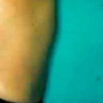 Liposuction Before & After Patient #2817
