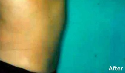 Liposuction Before & After Patient #2817