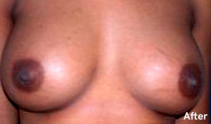 Breast Augmentation Before & After Patient #2199