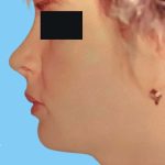 Rhinoplasty Before & After Patient #2958