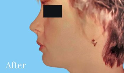 Rhinoplasty Before & After Patient #2958