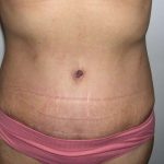 Tummy Tuck Before & After Patient #3048