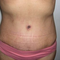 Tummy Tuck Before & After Patient #3048