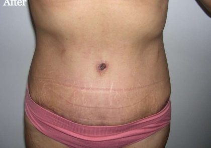 Tummy Tuck Before & After Patient #3048