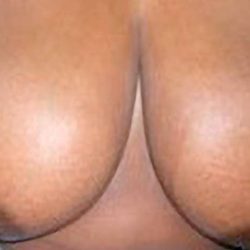 Breast Reduction Before & After Patient #2309