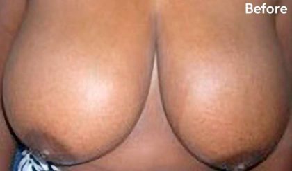 Breast Reduction Before & After Patient #2309