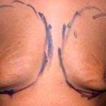 Breast Augmentation Before & After Patient #2199
