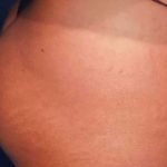 Buttock Augmentation Before & After Patient #2384