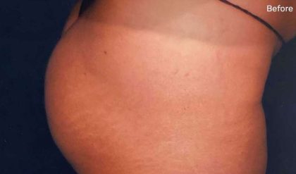 Buttock Augmentation Before & After Patient #2384