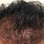 Hair Restoration Before & After Patient #2740