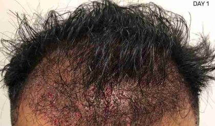 Hair Restoration Before & After Patient #2740