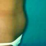 Liposuction Before & After Patient #2817