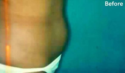 Liposuction Before & After Patient #2817