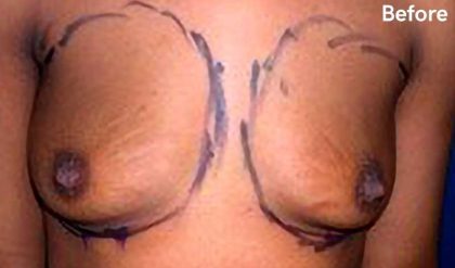 Breast Augmentation Before & After Patient #2199