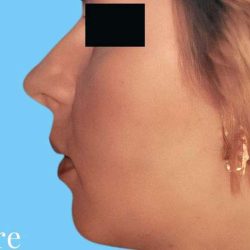 Rhinoplasty Before & After Patient #2958