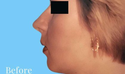 Rhinoplasty Before & After Patient #2958