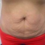 Tummy Tuck Before & After Patient #3048