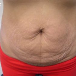 Tummy Tuck Before & After Patient #3048