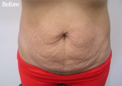 Tummy Tuck Before & After Patient #3048