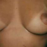 Breast Augmentation Before & After Patient #2202