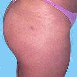 Buttock Augmentation Before & After Patient #2387