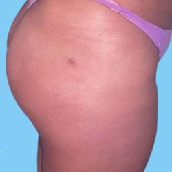Buttock Augmentation Before & After Patient #2387